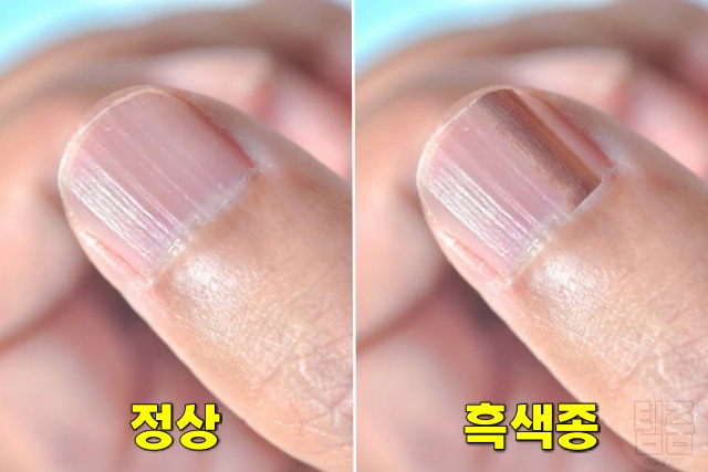 손톱에 세로줄이 생기는 이유, 손톱 검은 세로줄 흑색종 피부암, 손톱으로 보는 건강상태, 건강 팁줌 매일꿀정보