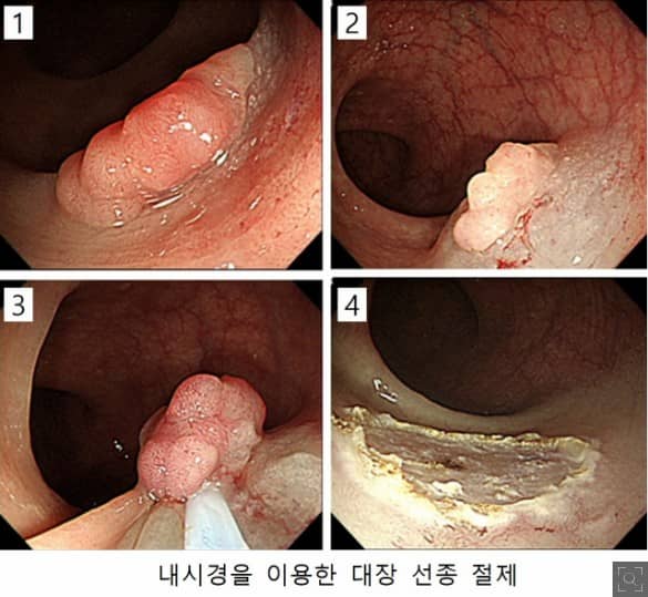 대장내시경&amp;#44; 대장내시경 전 음식주의사항&amp;#44; 대장내시경 전 먹어도 되는 음식&amp;#44; 대장내시경 약 복용법&amp;#44; 대장내시경 비용&amp;#44; 대장내시경 검사주기&amp;#44; 대장내시경 알약&amp;#44; 대장내시경 후 식사&amp;#44; 대장내시경 용종제거 보험비 청구&amp;#44; 대장내시경 전날 음식&amp;#44; 대장내시경 후 음식주의사항&amp;#44; 대장내시경 알약 복용법&amp;#44; 대장내시경 실비 청구&amp;#44; 대장내시경 약&amp;#44; 대장내시경 커피