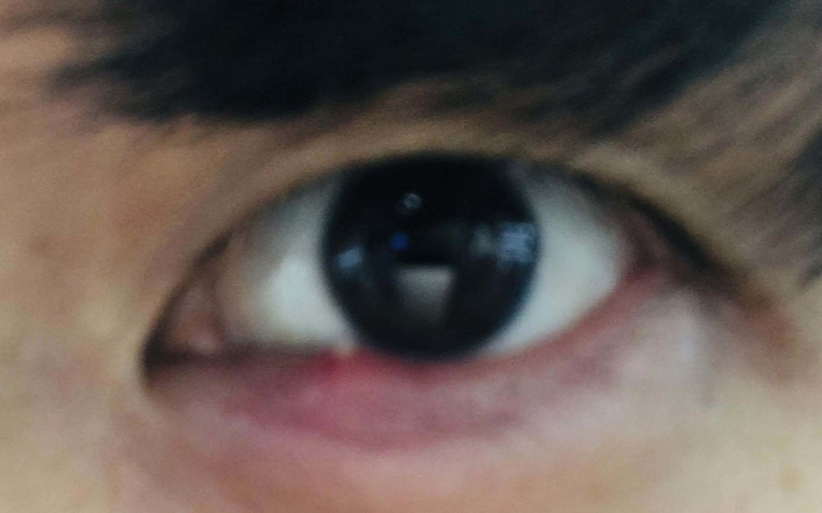 다래끼