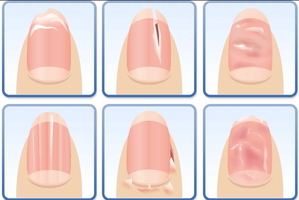 흑색종 자가진단 방법