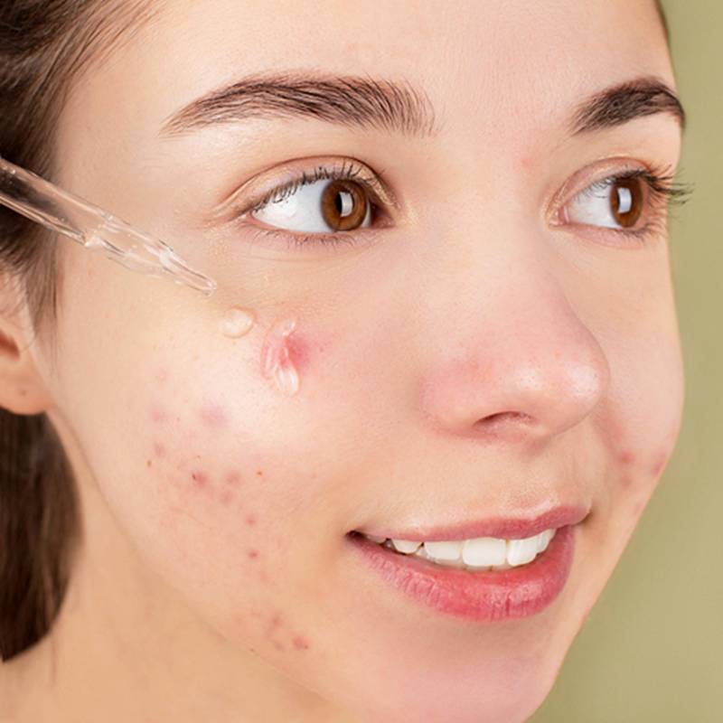 좁쌀 여드름 원인