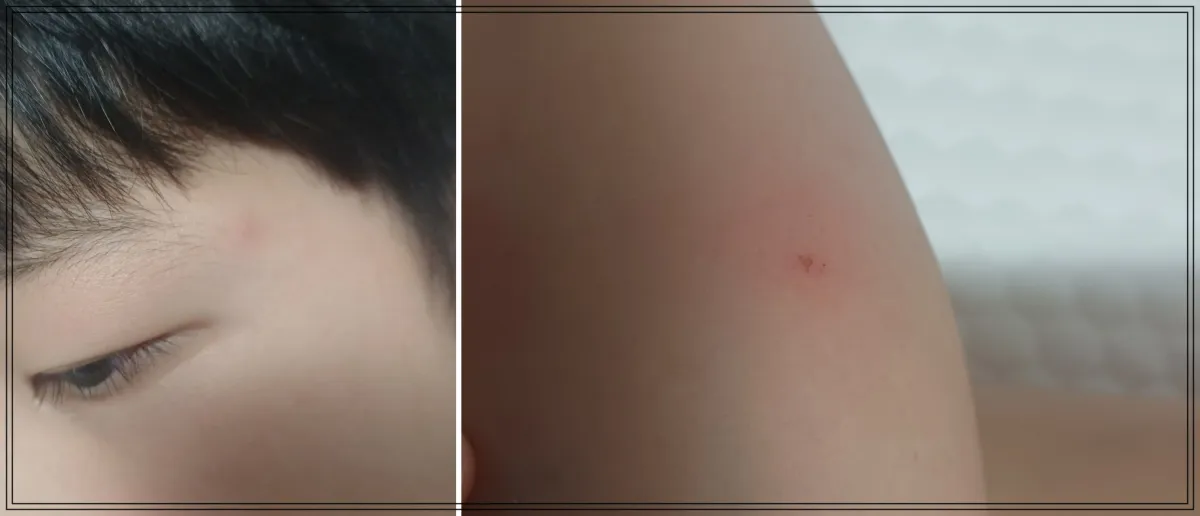 어린이-얼굴-눈-근처-모기물림-다리-붉은-반점-모기물린-자국
