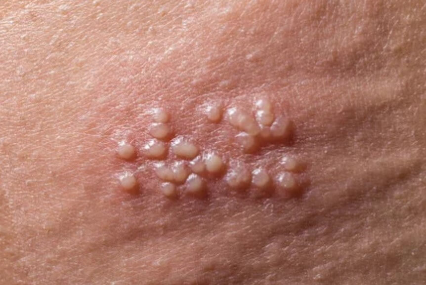 대상포진 초기증상 대상포진 조기치료 대상포진 초기증상 및 조기치료