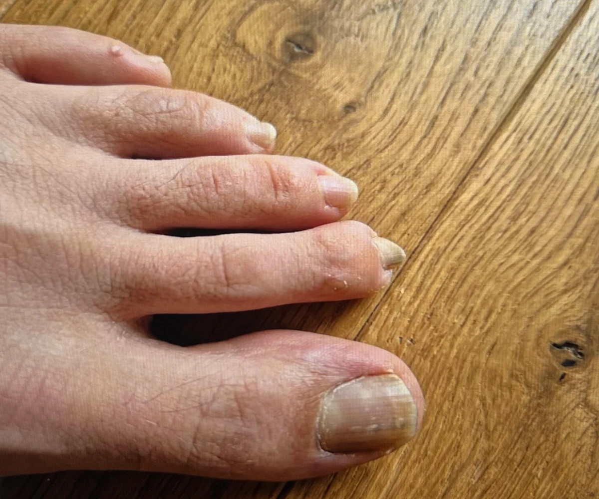 셀라큐어 문제성발톱 셀라솔루션 사용 전 발톱 사진