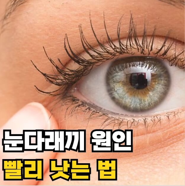 눈다래끼 원인 빨리 낫는 법