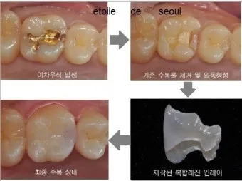 인레이 온레이의 차이와 치료 방법_20