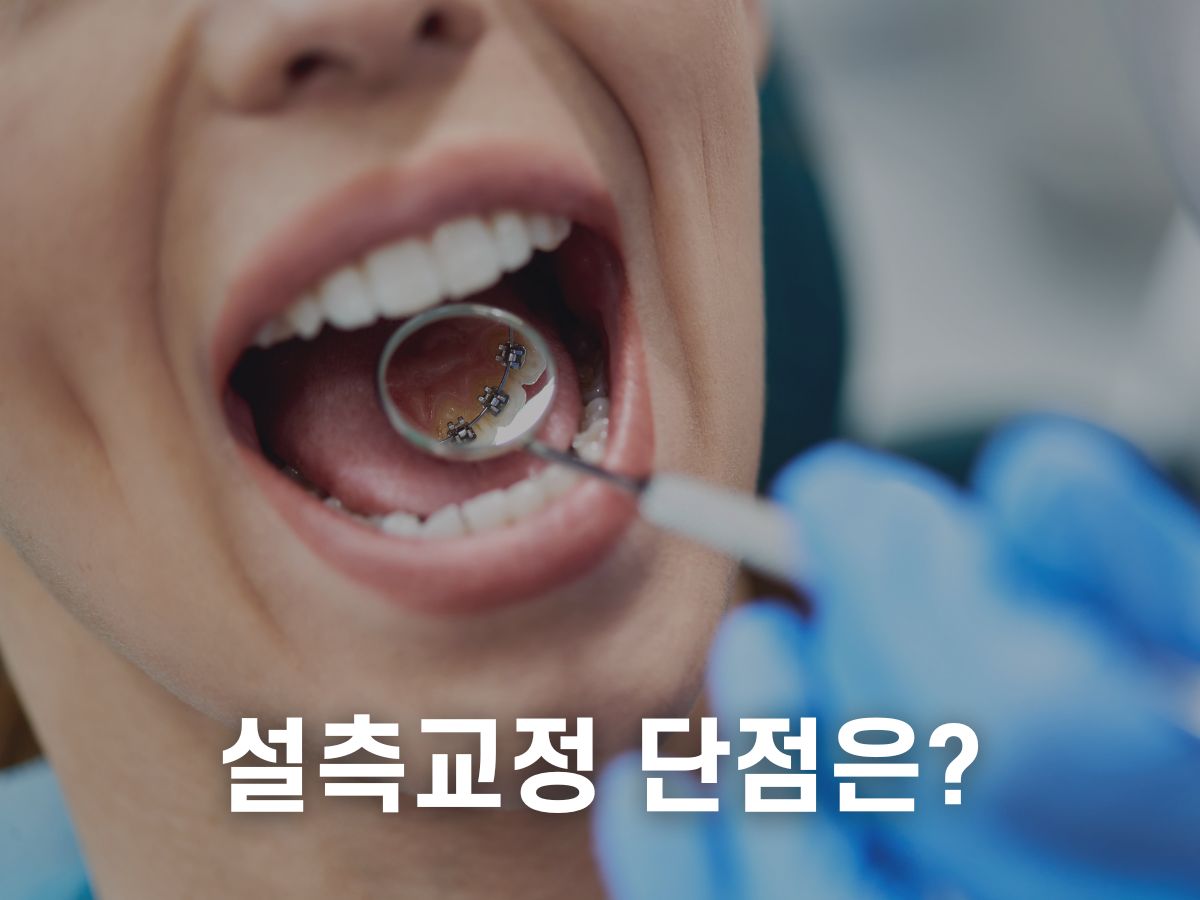 치아설측교정 단점