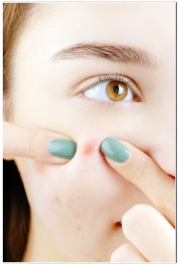 여드름 빨리 없애는 법