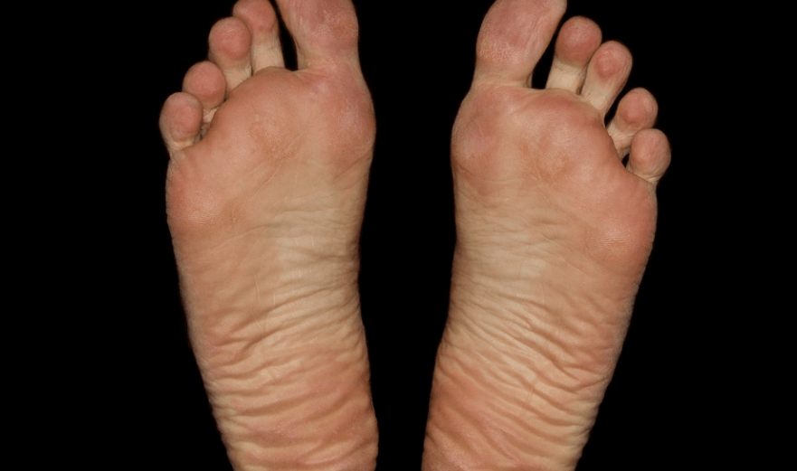 티눈 생기는 이유와 티눈 종류 및 예방법과 치료 방법 - 1