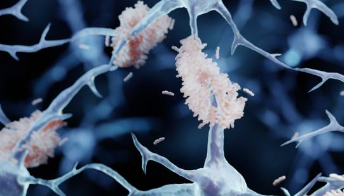 아밀로이드 플라크 