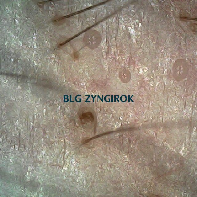 피나모아 복용 27주차 - 오른쪽 M자 부위 두피 모습이다.