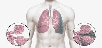폐에 물이 차는 원인
