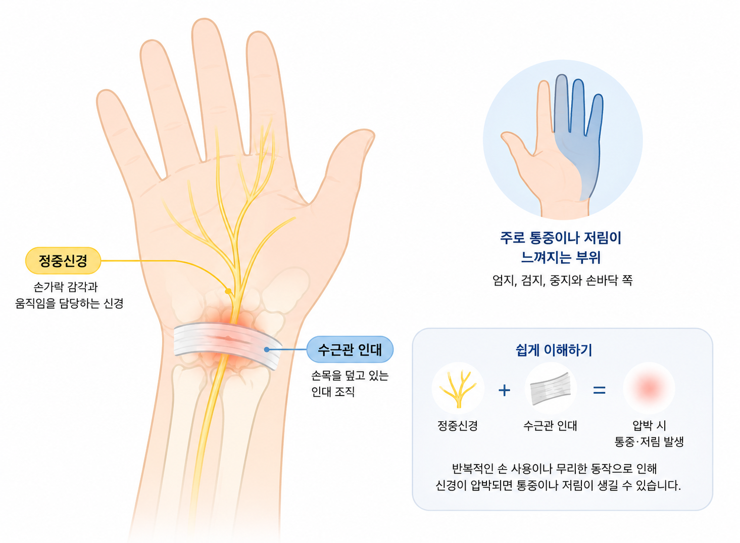 손목터널증후군증상정중신경