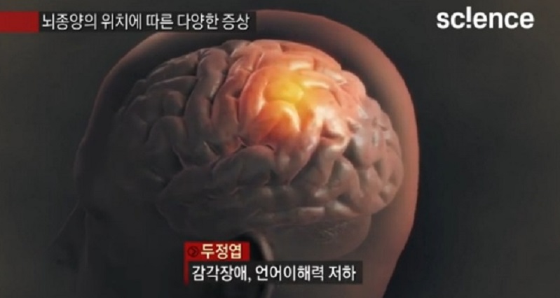 뇌종양위치에따른증상