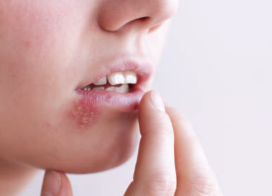 대상포진 초기증상 치료방법 예방법 총정리