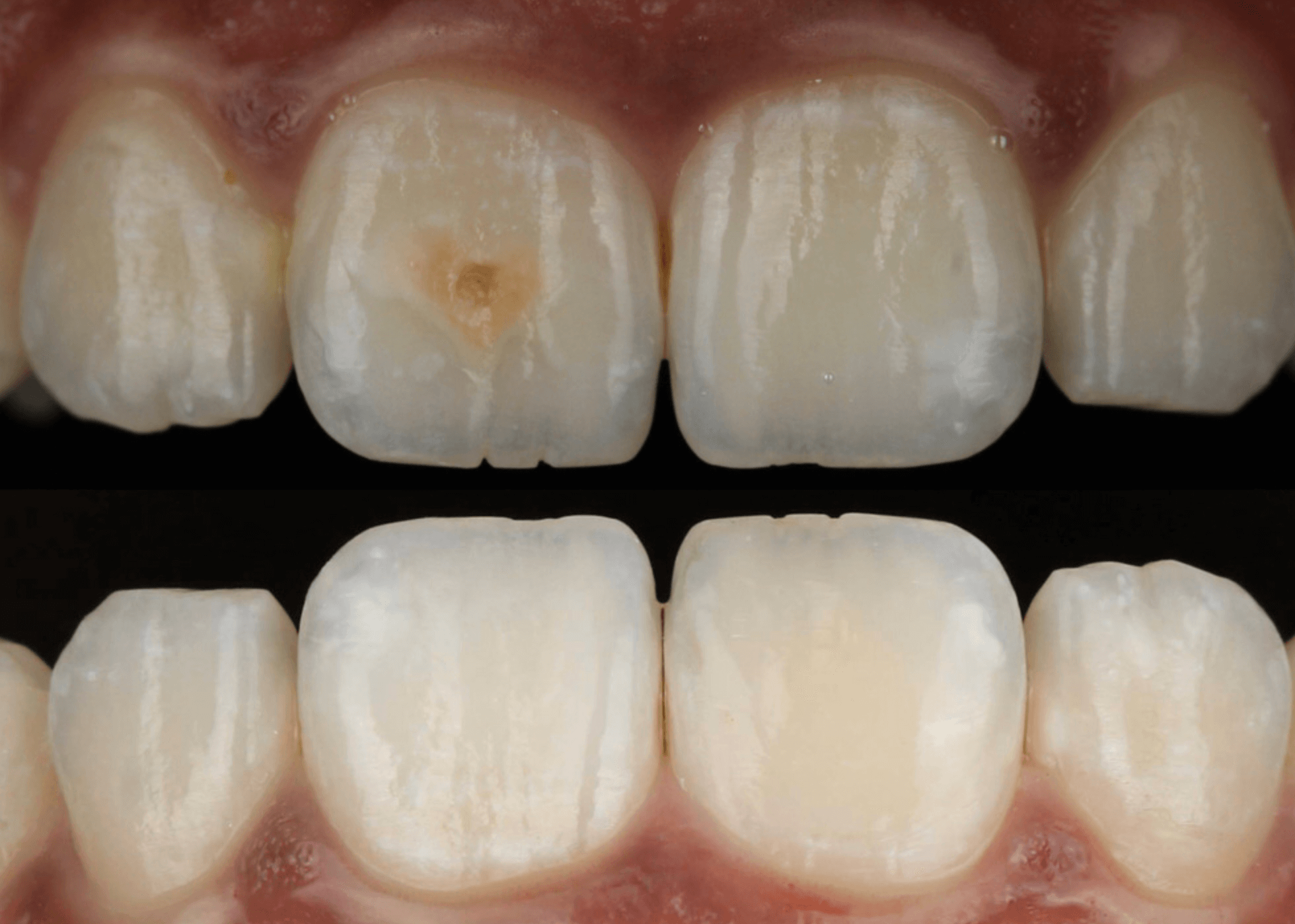 앞니 치아 레진