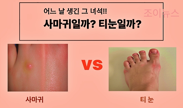사마귀, 티눈 차이점과 치료법은?
