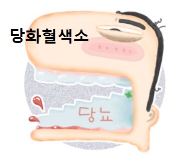 당뇨-치주환자