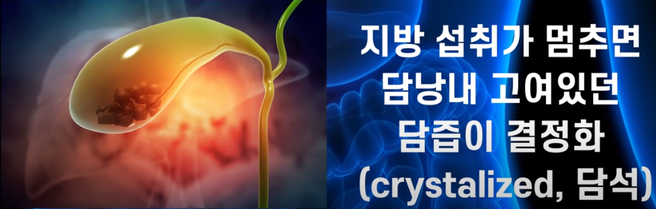 담석이 생기는 원인