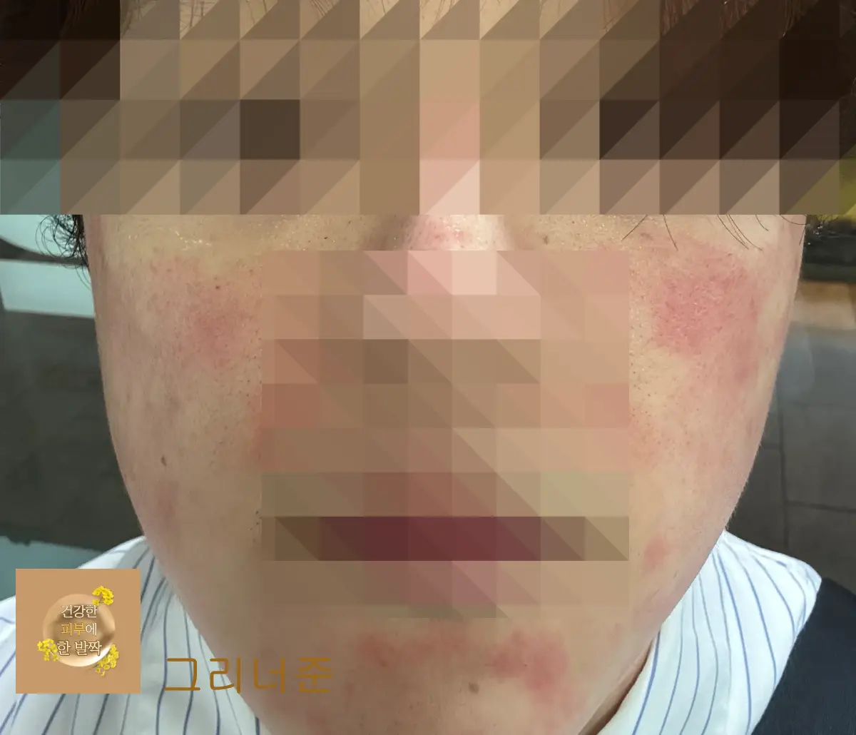 시술-후-피부상태-피부-붉어짐