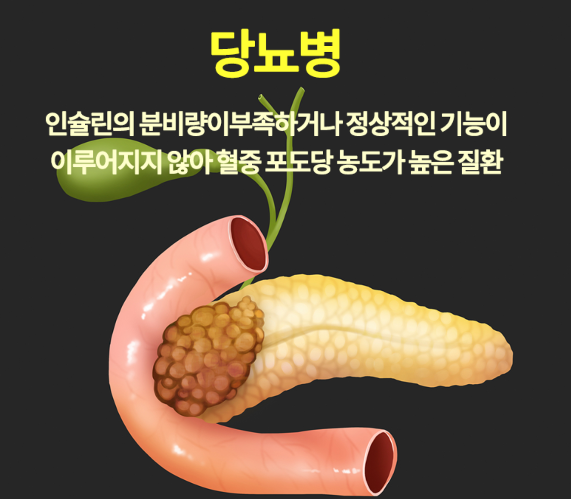 췌장암