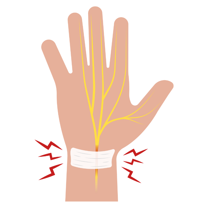손목터널증후군 증상