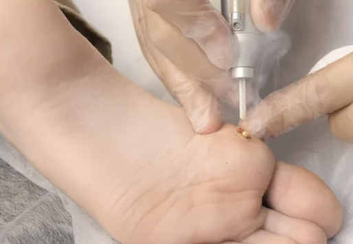 사마귀 제거방법 6