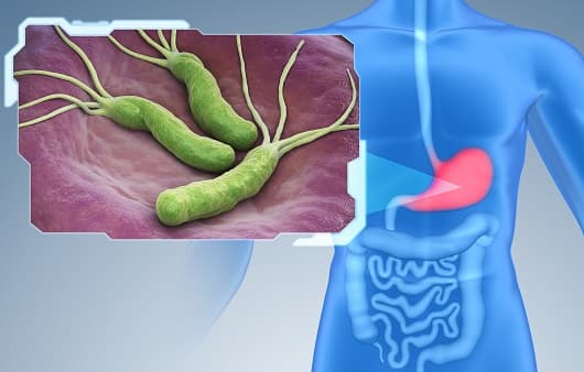 장누수증후군(Leaky Gut)과 IBS의 관계