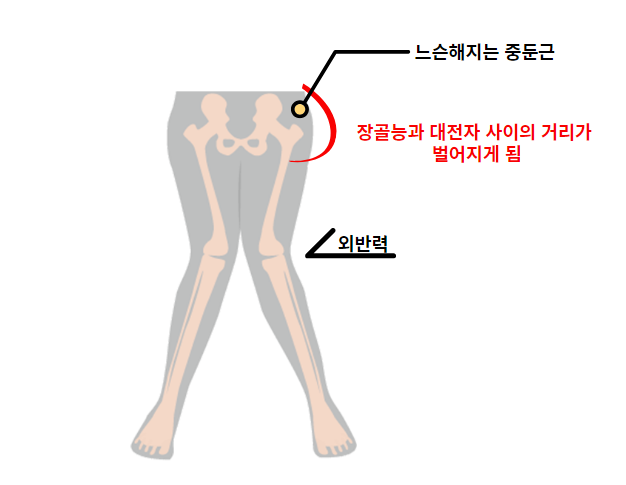 무릎통증과 외반슬