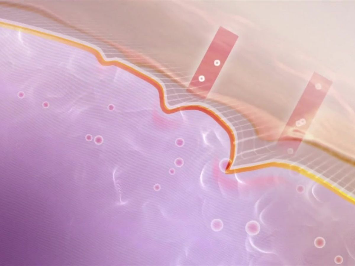 비절개 안면거상술 원리