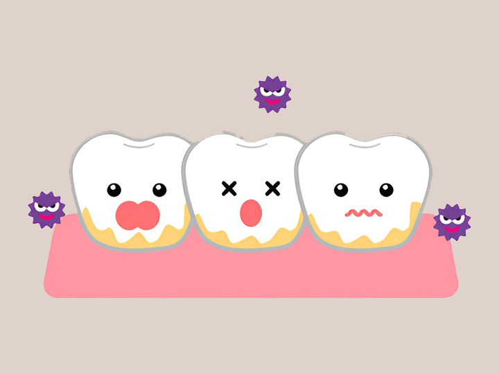 치태와-치석이-쌓인-치아
