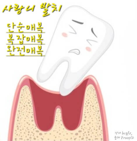 사랑니발치