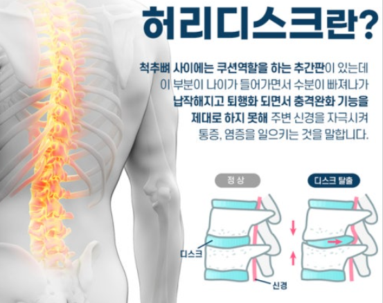 허리 디스크 관련 사진