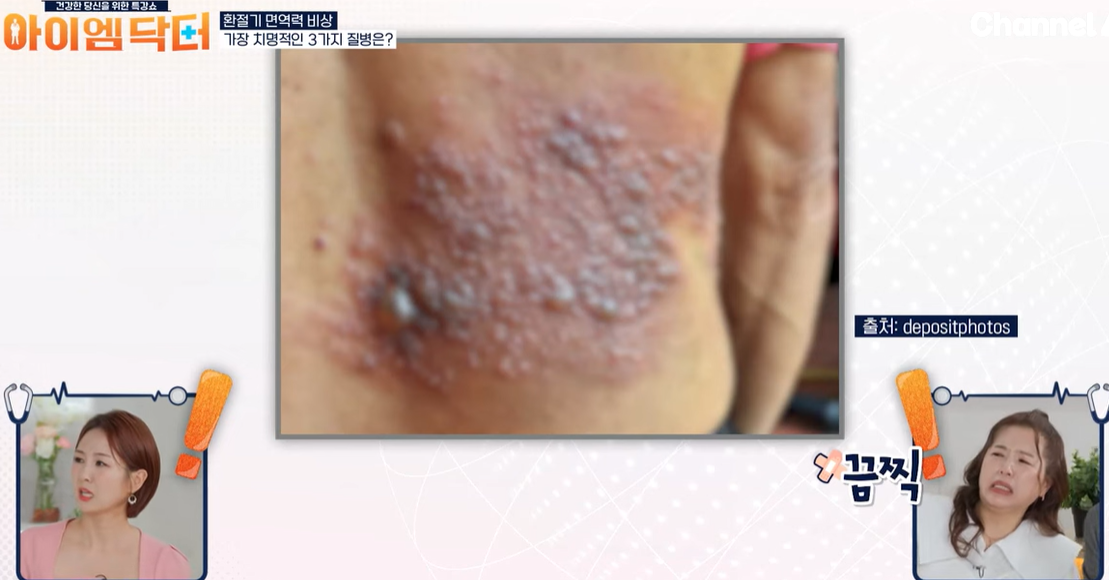 대상포진의 예를 보여주는 사진