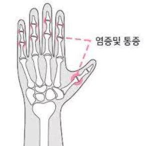 손가락-퇴행성-관절염-치료법-및-예방법