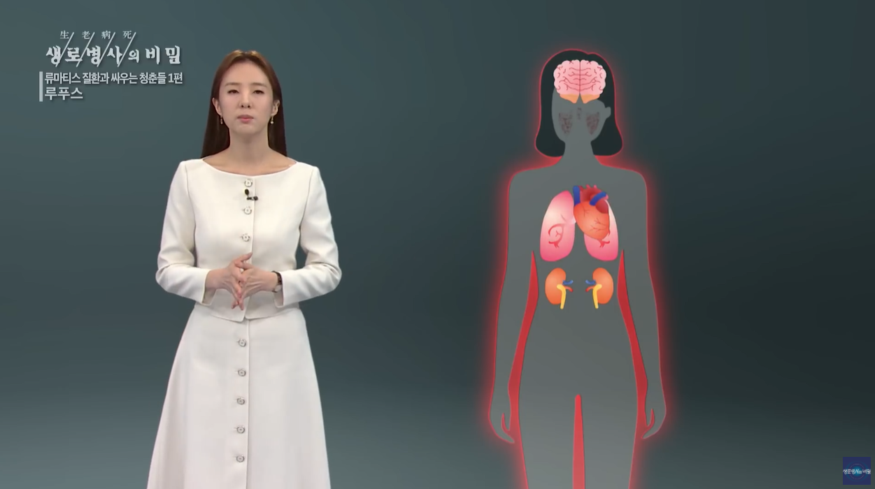 루프스 천의얼굴 동행의병 제2의삶 관리의시대