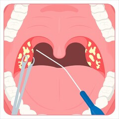 편도결석 빼는법&amp;#44; 집에서 빼는법 및 예방법을 알아봤습니다. 집에서 편도결석 빼는법과 병원에서는 편도결석을 어떻게 제거하는지 참고하시기 바랍니다. 