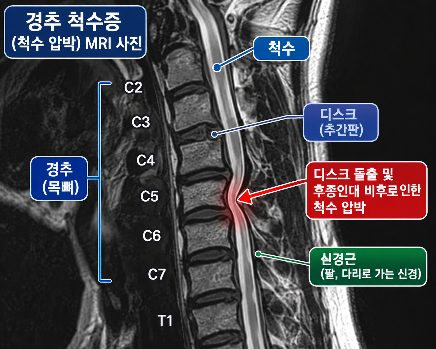 경추 척수증 MRI 척수 압박