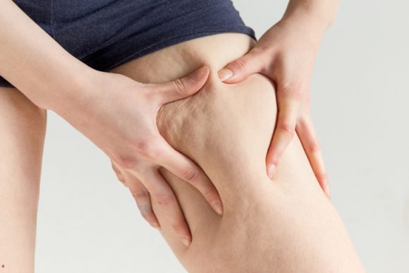 셀룰라이트 없애는 법