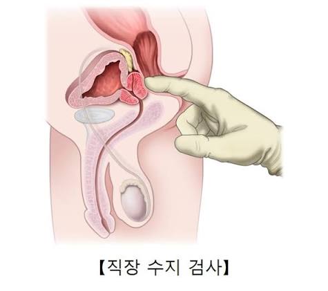 전립선 비대증 관련 사진