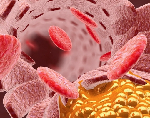 중성지방 수치가 높아지면