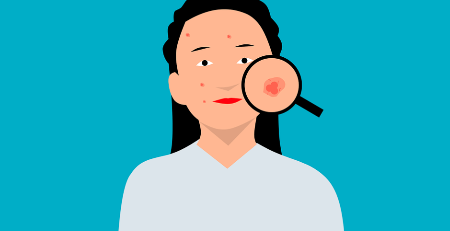 여드름이 나 있는 모습 - 6