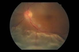 비문증 치료방법