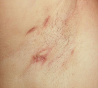 화농성 한선염 치료 수술 병원