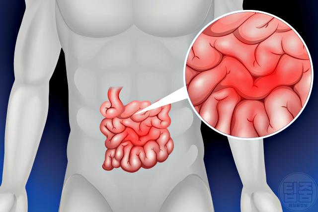 장염 잘 생기는 사람 이유
