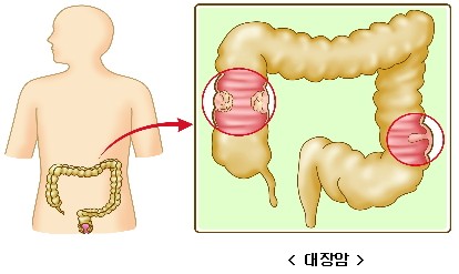 대장암 초기증상