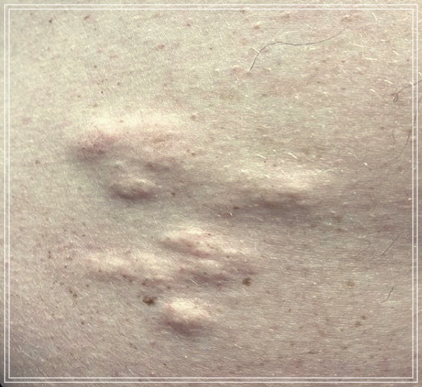 얼굴 지방종 제거 방법