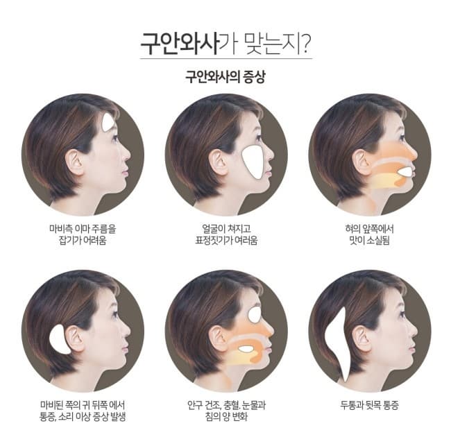 구안와사 증상