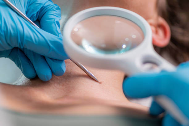 편평사마귀, 단순 제거로 끝나지 않는다? 면역치료로 근본 치료하기