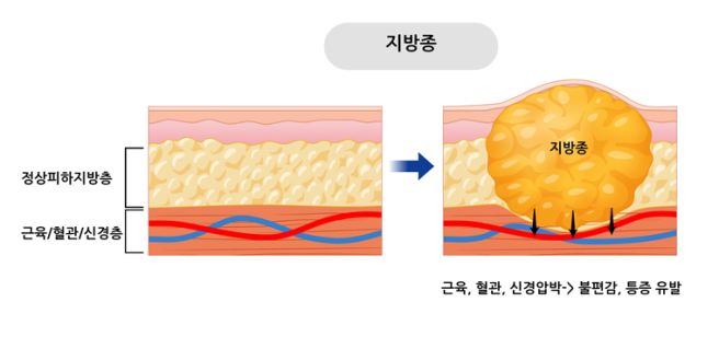 지방종 원인